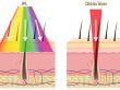 Az IPL és a dióda lézeres szőrtelenítés közötti fő különbség a használ fény hullámhosszában van. | Lézeres szőrtelenítés Angyalföldön